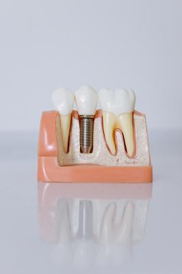 Different Types of Dental Implants