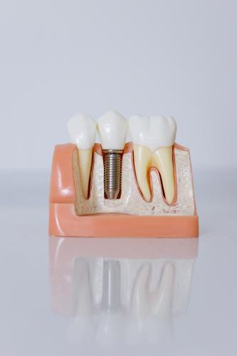 Types of Dental Implants