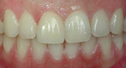 After Cosmetic Dentistry | Kneib Dentistry