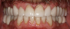 After Dental Implants