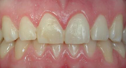 After Tissue Recontouring | Kneib Dentistry in Erie, PA