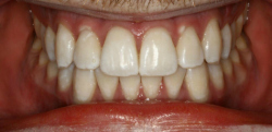 After Zoom Whitening | Kneib Dentistry