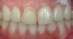 Before Cosmetic Dentistry | Kneib Dentistry