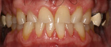 Before Dental Implants