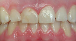 Before Tissue Recontouring | Kneib Dentistry in Erie, PA