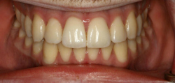 Before Zoom Whitening | Kneib Dentistry