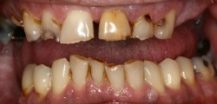 Before Complete Upper Denture | Kneib Dentistry in Erie, PA