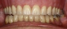 After Complete Upper Denture | Kneib Dentistry in Erie, PA