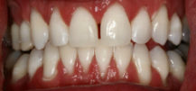 After Zoom Whitening