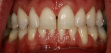 Before Zoom Whitening