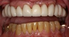 Full Upper Arch Resin Bridge | Kneib Dentistry in Erie, PA