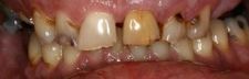 Before Dental Crowns