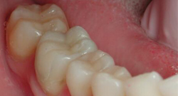 After Dental Crowns