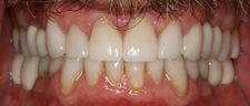 After Dental Crowns