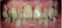 Before Dental Crowns