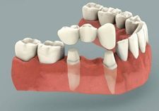 Traditional Dental Bridge | Kneib Dentistry in Erie, PA