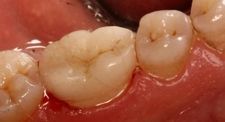 After CAD/CAM Crowns | Kneib Dentistry in Erie, PA