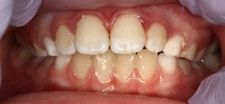 After Dental Bonding | Kneib Dentistry in Erie, PA
