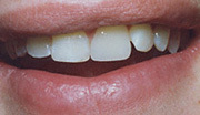 After Dental Bonding | Kneib Dentistry