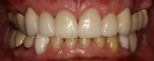 After Dental Crowns | Kneib Dentistry in Erie, PA