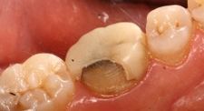 Before CAD/CAM Crowns | Kneib Dentistry in Erie, PA