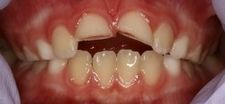 Before Dental Bonding | Kneib Dentistry in Erie, PA