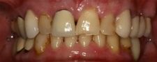 Before Dental Crowns | Kneib Dentistry in Erie, PA
