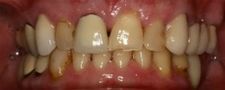 Before Dental Crowns | Kneib Dentistry in Erie, PA