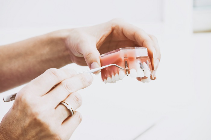 Dental Implant Model | Kneib Dentistry in Erie, PA