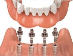 Over-Dentures | Kneib Dentistry in Erie, PA